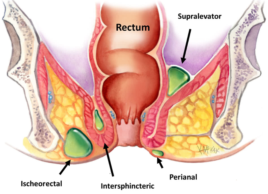 best fistula surgeon in Aurangabad- Dr. Anand Auti