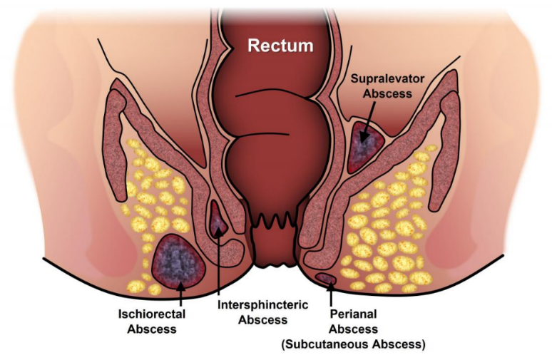 Fistula Treatment – Why is Surgery the Right Option?